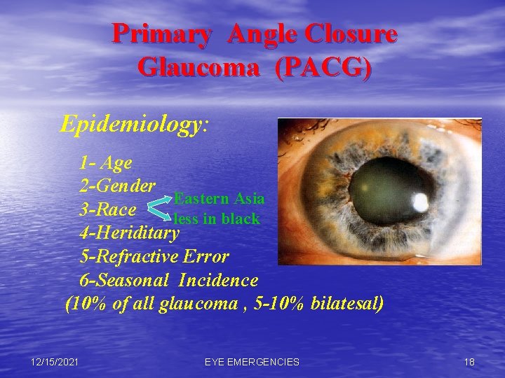 Primary Angle Closure Glaucoma (PACG) Epidemiology: 1 - Age 2 -Gender Eastern Asia 3