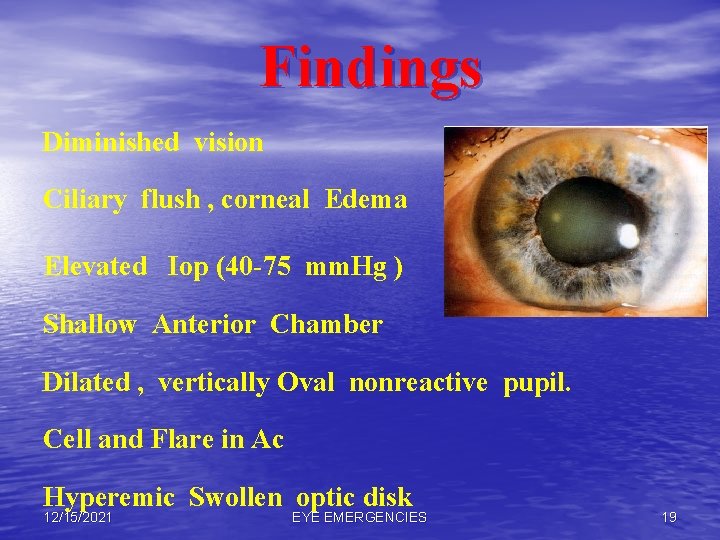 Findings Diminished vision Ciliary flush , corneal Edema Elevated Iop (40 -75 mm. Hg