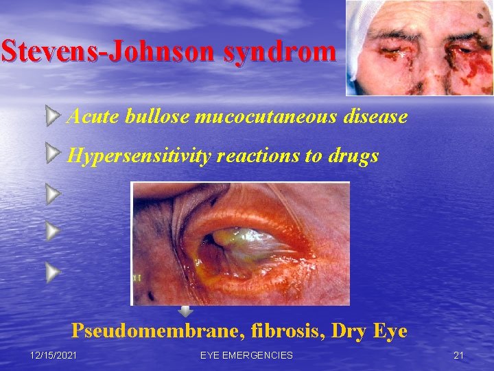 Stevens-Johnson syndrom Acute bullose mucocutaneous disease Hypersensitivity reactions to drugs Pseudomembrane, fibrosis, Dry Eye