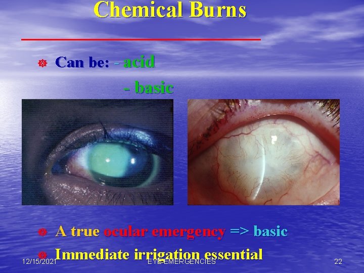 Chemical Burns ] Can be: - acid - basic A true ocular emergency =>