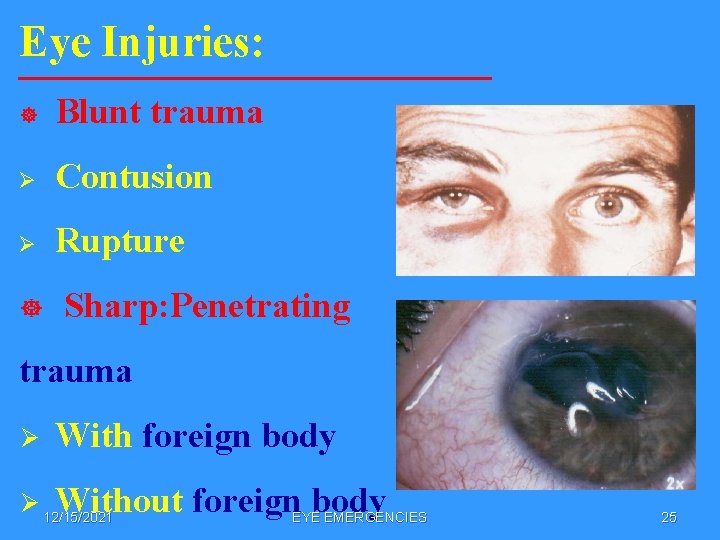 Eye Injuries: ] Blunt trauma Ø Contusion Ø Rupture ] Sharp: Penetrating trauma Ø