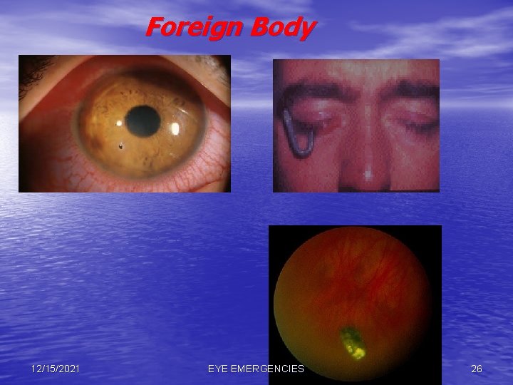 Foreign Body 12/15/2021 EYE EMERGENCIES 26 