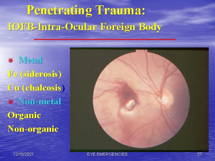 Penetrating Trauma: IOFB-Intra-Ocular Foreign Body Metal Fe (siderosis) Cu (chalcosis) ¯ Non-metal Organic Non-organic