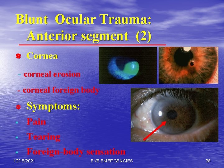 Blunt Ocular Trauma: Anterior segment (2) | Cornea - corneal erosion - corneal foreign