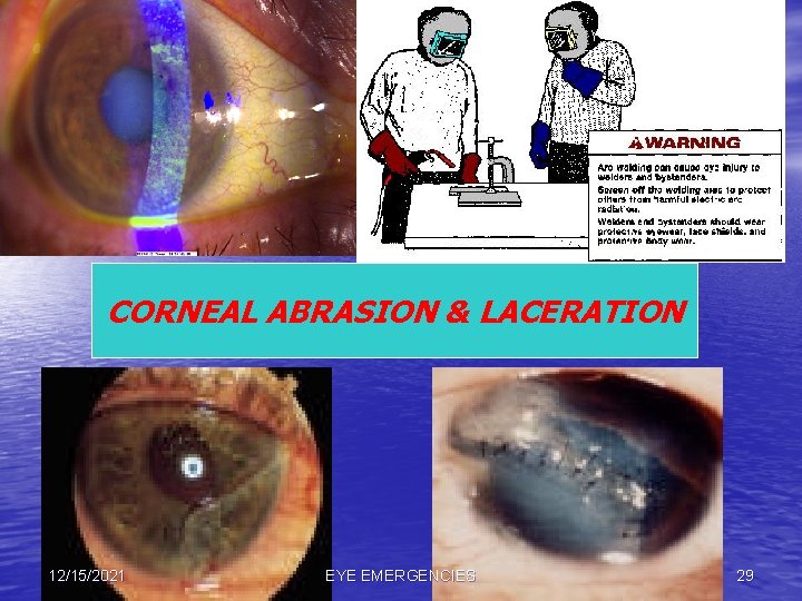 CORNEAL ABRASION & LACERATION 12/15/2021 EYE EMERGENCIES 29 