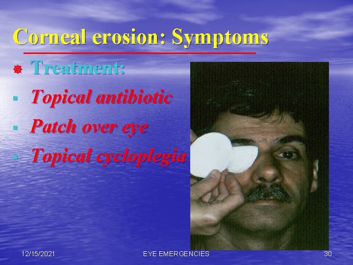 Corneal erosion: Symptoms ] § § § Treatment: Topical antibiotic Patch over eye Topical