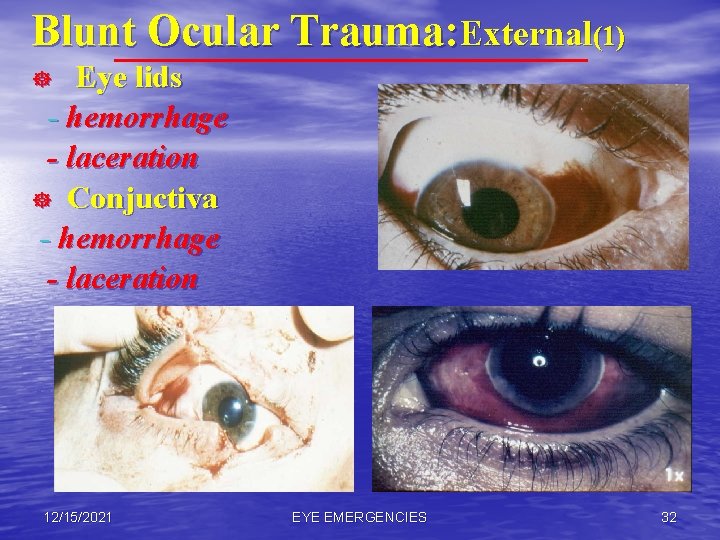 Blunt Ocular Trauma: External(1) Eye lids - hemorrhage - laceration ] Conjuctiva - hemorrhage