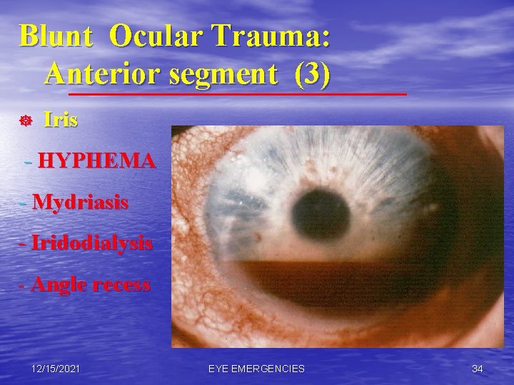 Blunt Ocular Trauma: Anterior segment (3) ] Iris - HYPHEMA - Mydriasis - Iridodialysis