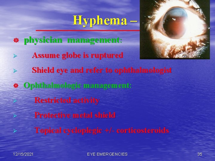 Hyphema – ] physician management: Ø Assume globe is ruptured Ø Shield eye and