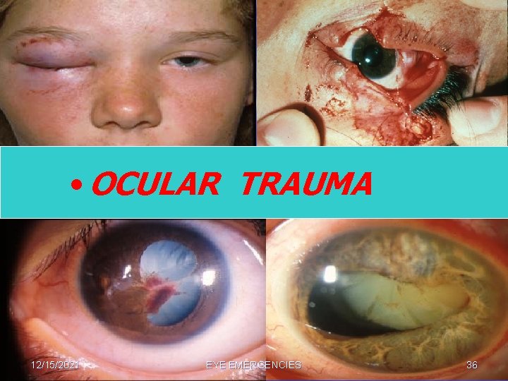  • OCULAR TRAUMA 12/15/2021 EYE EMERGENCIES 36 