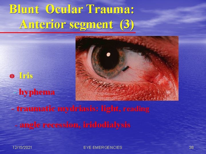 Blunt Ocular Trauma: Anterior segment (3) ] Iris - hyphema - traumatic mydriasis: light,