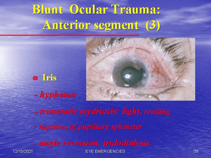 Blunt Ocular Trauma: Anterior segment (3) ] Iris - hyphema - traumatic mydriasis: light,