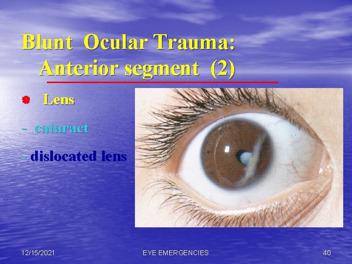 Blunt Ocular Trauma: Anterior segment (2) | Lens - cataract - dislocated lens 12/15/2021