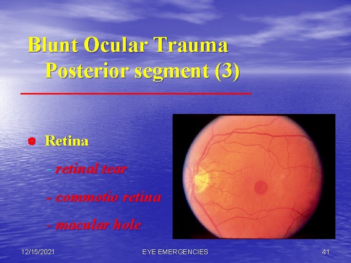 Blunt Ocular Trauma Posterior segment (3) | Retina - retinal tear - commotio retina