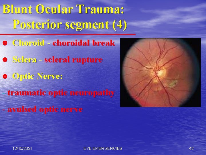 Blunt Ocular Trauma: Posterior segment (4) | Choroid - choroidal break | Sclera -