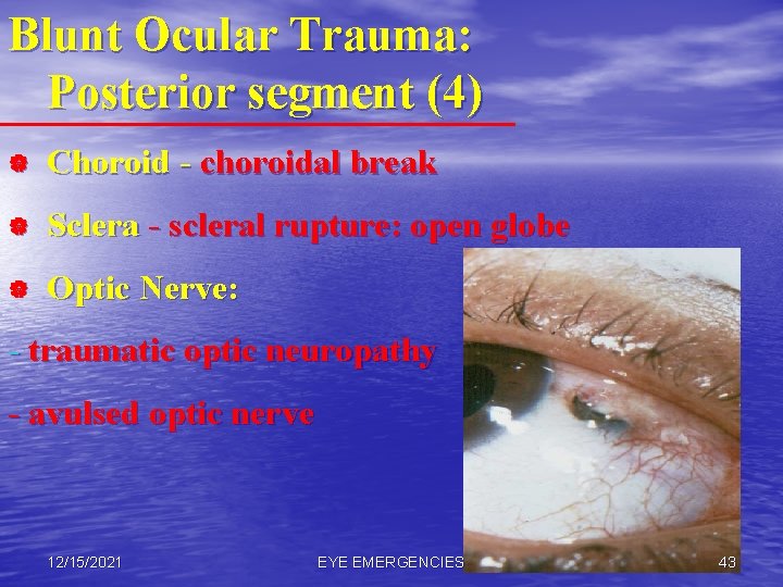 Blunt Ocular Trauma: Posterior segment (4) | Choroid - choroidal break | Sclera -