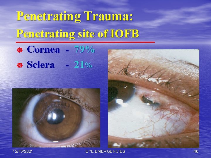 Penetrating Trauma: Penetrating site of IOFB ] ] Cornea - 79% Sclera - 21%