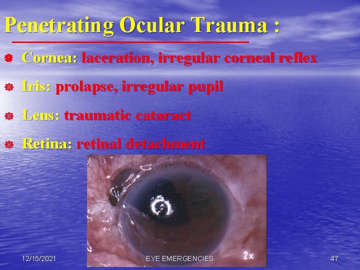 Penetrating Ocular Trauma : | Cornea: laceration, irregular corneal reflex ] Iris: prolapse, irregular