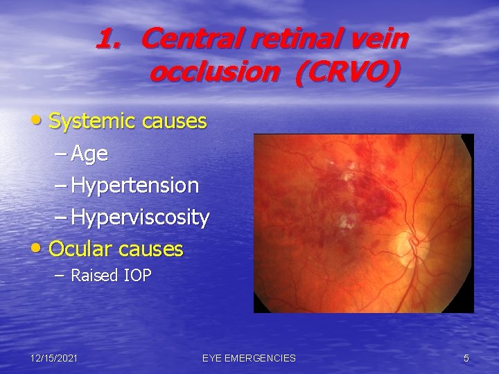 1. Central retinal vein occlusion (CRVO) • Systemic causes – Age – Hypertension –