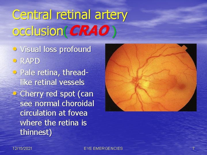 Central retinal artery occlusion(CRAO ) • Visual loss profound • RAPD • Pale retina,