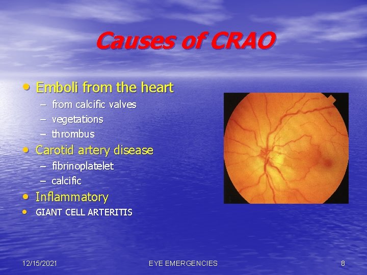 Causes of CRAO • Emboli from the heart – – – from calcific valves
