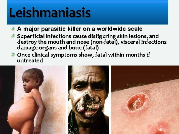 Leishmaniasis A major parasitic killer on a worldwide scale Superficial infections cause disfiguring skin