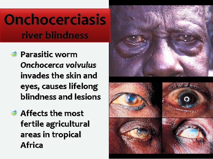 Onchocerciasis river blindness Parasitic worm Onchocerca volvulus invades the skin and eyes, causes lifelong