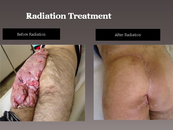 Radiation Treatment Before Radiation After Radiation 