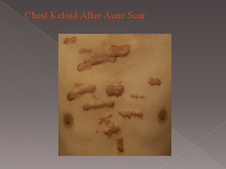 Chest Keloid After Acne Scar 