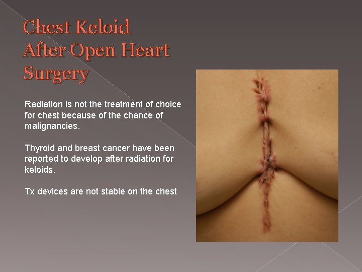 Chest Keloid After Open Heart Surgery Radiation is not the treatment of choice for