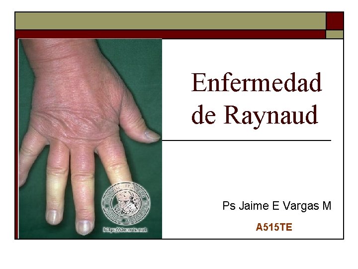 Enfermedad de Raynaud Ps Jaime E Vargas M A 515 TE 