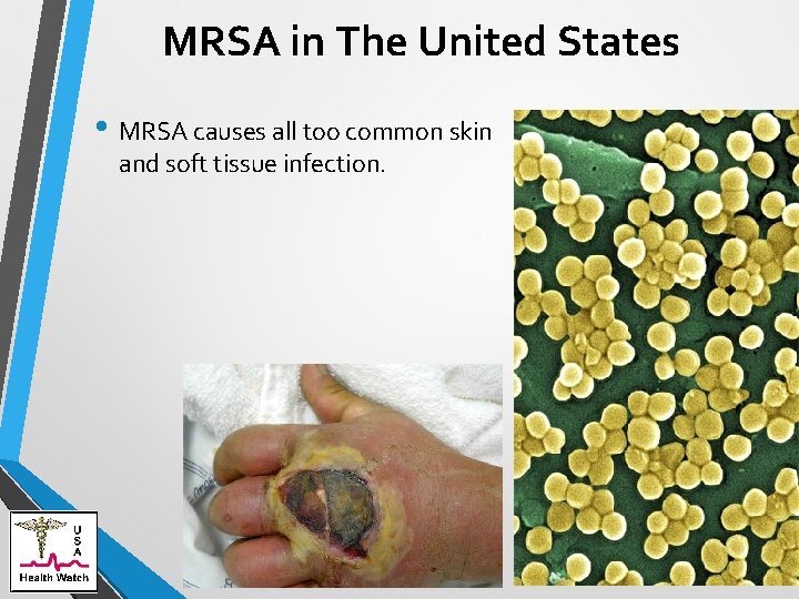 MRSA in The United States • MRSA causes all too common skin and soft