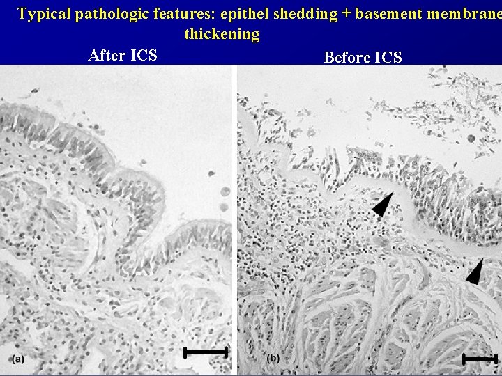 Typical pathologic features: epithel shedding + basement membrane thickening After ICS Before ICS 