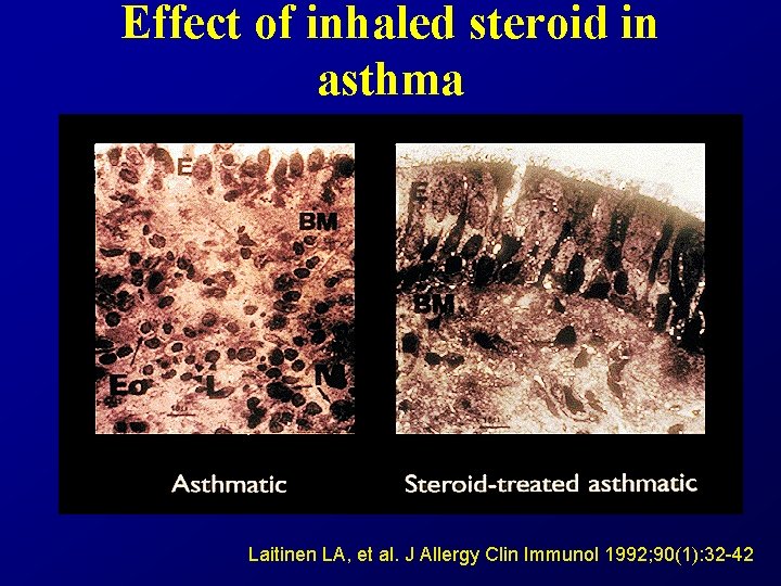 Effect of inhaled steroid in asthma Laitinen LA, et al. J Allergy Clin Immunol