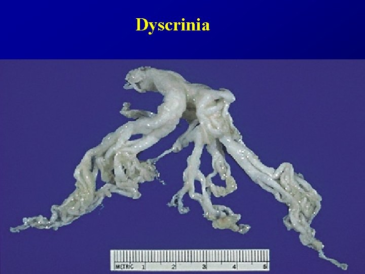 Dyscrinia 