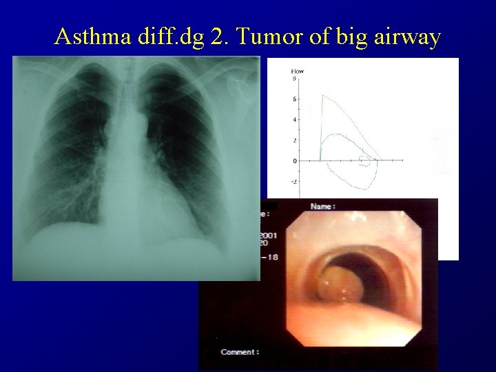 Asthma diff. dg 2. Tumor of big airway 