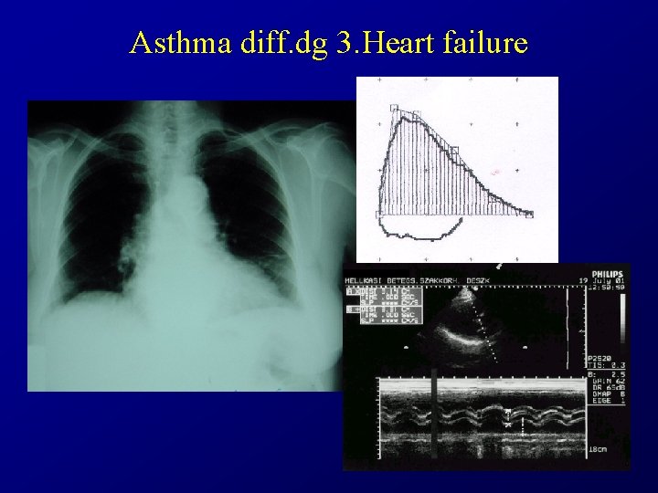 Asthma diff. dg 3. Heart failure 