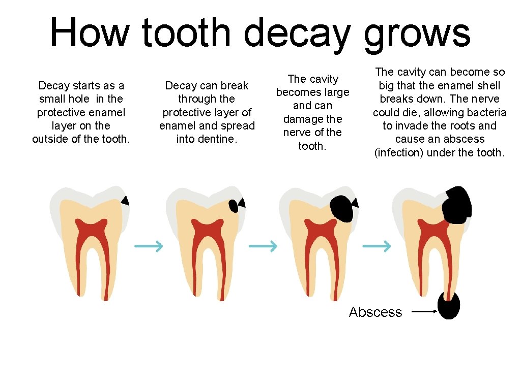 How tooth decay grows Decay starts as a small hole in the protective enamel