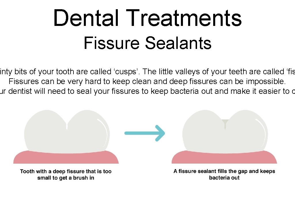 Dental Treatments Fissure Sealants inty bits of your tooth are called ‘cusps’. The little