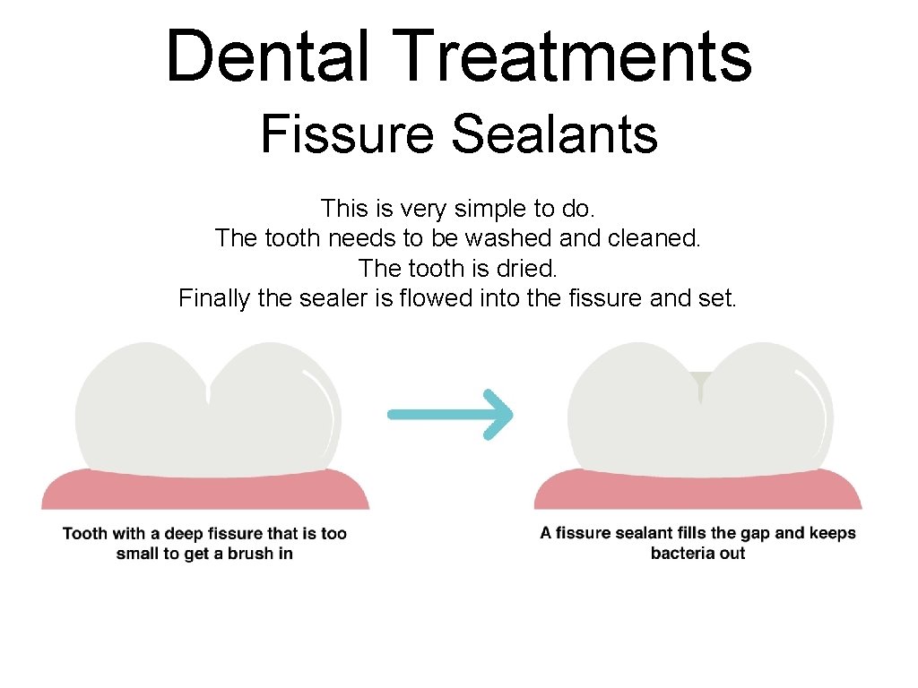 Dental Treatments Fissure Sealants This is very simple to do. The tooth needs to