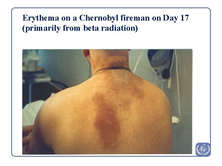 Erythema on a Chernobyl fireman on Day 17 (primarily from beta radiation) 