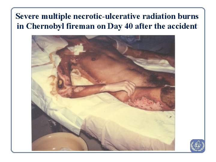 Severe multiple necrotic-ulcerative radiation burns in Chernobyl fireman on Day 40 after the accident