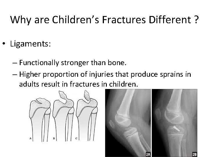 Why are Children’s Fractures Different ? • Ligaments: – Functionally stronger than bone. –