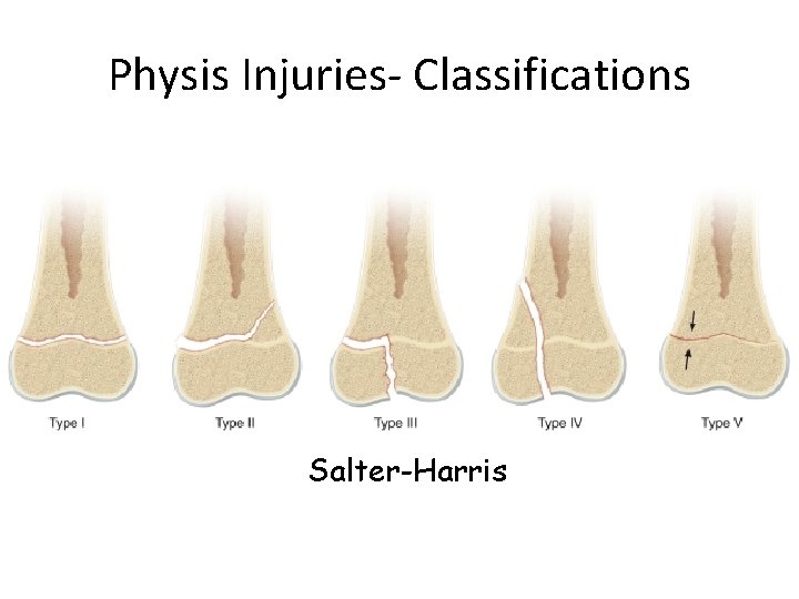 Physis Injuries- Classifications Salter-Harris 