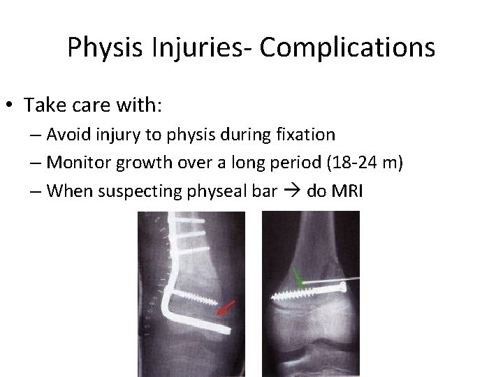 Physis Injuries- Complications • Take care with: – Avoid injury to physis during fixation