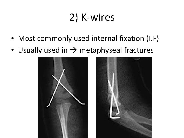 2) K-wires • Most commonly used internal fixation (I. F) • Usually used in