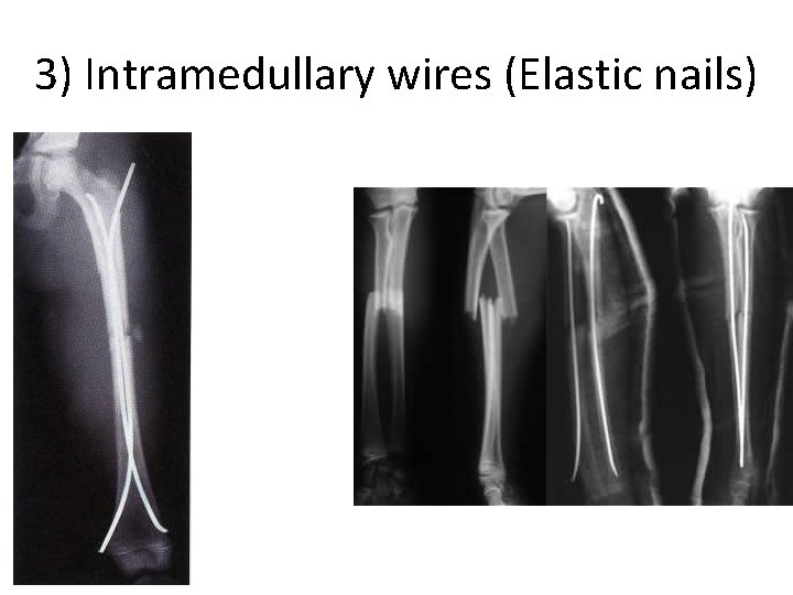 3) Intramedullary wires (Elastic nails) 