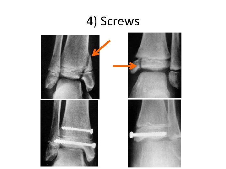 4) Screws 