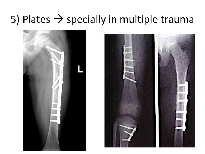 5) Plates specially in multiple trauma 