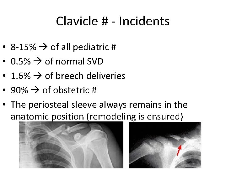 Clavicle # - Incidents • • • 8 -15% of all pediatric # 0.